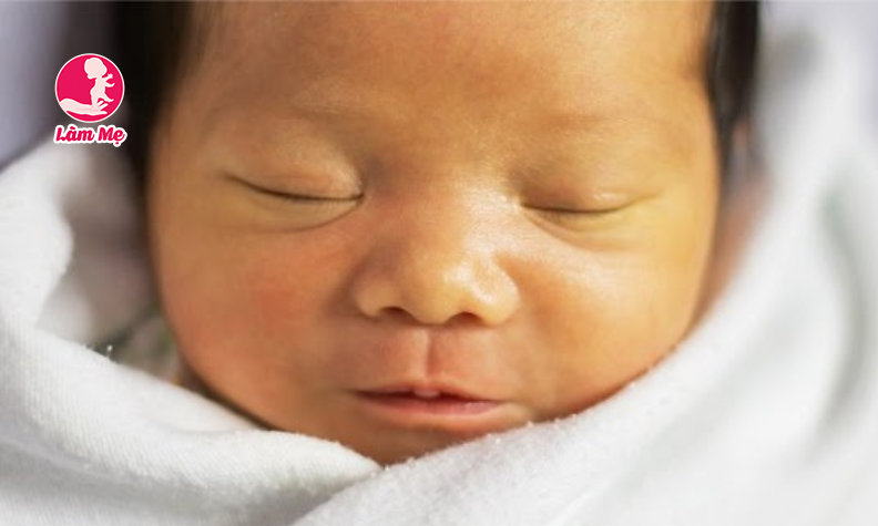 Em bé bị vàng da: Nguyên nhân, dấu hiệu và cách điều trị